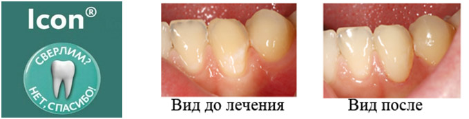 Лечение кариеса ICON Томск Кооперативный Отбеливание зубов Luma Cool Томск Крестьянский